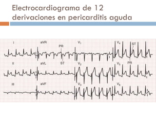 Electrocardiograma de 12 derivaciones en pericarditis aguda 