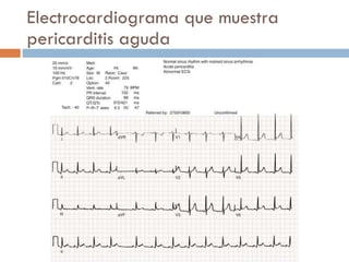 Electrocardiograma que muestra pericarditis aguda 