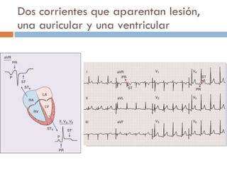 Dos corrientes que aparentan lesión, una auricular y una ventricular 