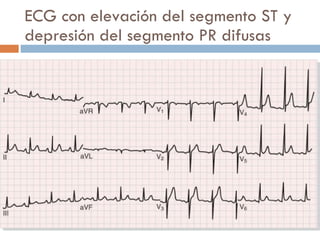 ECG con elevación del segmento ST y depresión del segmento PR difusas 