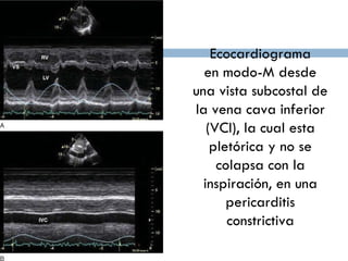 Ecocardiograma en modo-M desde una vista subcostal de la vena cava inferior (VCI), la cual esta pletórica y no se colapsa con la inspiración, en una pericarditis constrictiva 