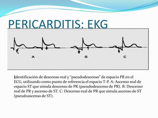 PERICARDITIS: EKG


 Identificación de descenso real y “pseudodescenso” de espacio PR en el
 ECG, utilizando como punto de referencia el espacio T-P. A: Ascenso real de
 espacio ST que simula descenso de PR (pseudodescenso de PR). B: Descenso
 real de PR y ascenso de ST. C: Descenso real de PR que simula ascenso de ST
 (pseudoascenso de ST).
 