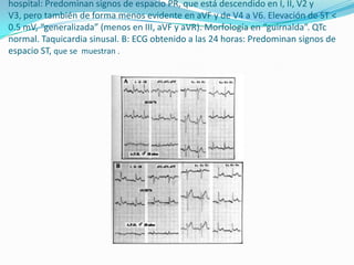 hospital: Predominan signos de espacio PR, que está descendido en I, II, V2 y
V3, pero también de forma menos evidente en aVF y de V4 a V6. Elevación de ST <
0.5 mV, “generalizada” (menos en III, aVF y aVR). Morfología en “guirnalda”. QTc
normal. Taquicardia sinusal. B: ECG obtenido a las 24 horas: Predominan signos de
espacio ST, que se muestran .
 