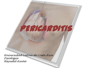 PERICARDITIS

Universidad Latina de Costa Rica
Fisiología
Nayudel Acuña
 