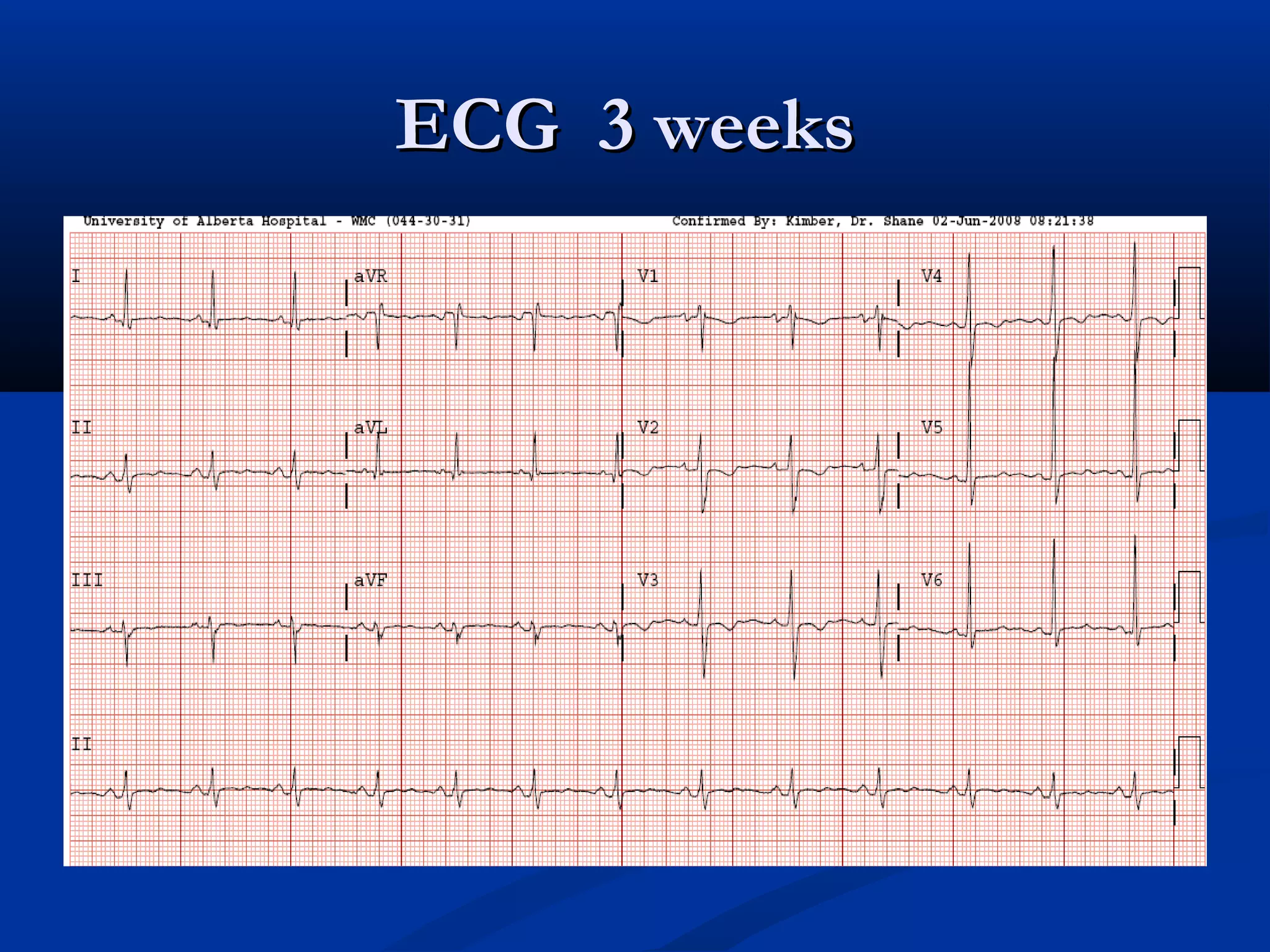 ECG 3 weeks
 
