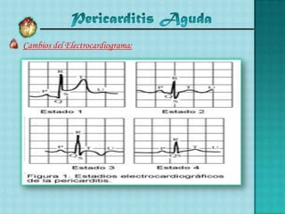 Cambios del Electrocardiograma:

 