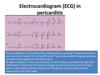 Electrocardiogram (ECG) in
pericarditis
Electrocardiogram in acute pericarditis showing diffuse upsloping ST segment elevations
seen best here in leads II, III, aVF, and V2 to V6. There is also subtle PR segment deviation
(positive in aVR, negative in most other leads).
ST segment elevation is due to a ventricular current of injury associated with epicardial
inflammation; similarly, the PR segment changes are due to an atrial current of injury
which, in pericarditis, typically displaces the PR segment upward in lead aVR and
downward in most other leads.
 