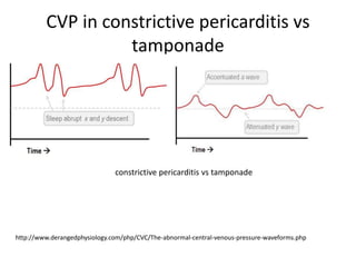 CVP in constrictive pericarditis vs
tamponade
constrictive pericarditis vs tamponade
http://www.derangedphysiology.com/php/CVC/The-abnormal-central-venous-pressure-waveforms.php
 