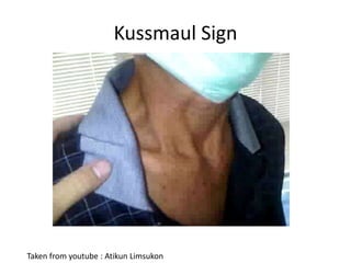 Kussmaul Sign
Taken from youtube : Atikun Limsukon
 