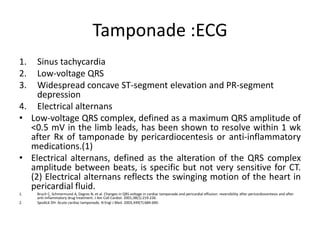 Tamponade :ECG
1. Sinus tachycardia
2. Low-voltage QRS
3. Widespread concave ST-segment elevation and PR-segment
depression
4. Electrical alternans
• Low-voltage QRS complex, defined as a maximum QRS amplitude of
<0.5 mV in the limb leads, has been shown to resolve within 1 wk
after Rx of tamponade by pericardiocentesis or anti-inflammatory
medications.(1)
• Electrical alternans, defined as the alteration of the QRS complex
amplitude between beats, is specific but not very sensitive for CT.
(2) Electrical alternans reflects the swinging motion of the heart in
pericardial fluid.
1. Bruch C, Schmermund A, Dagres N, et al. Changes in QRS voltage in cardiac tamponade and pericardial effusion: reversibility after pericardiocentesis and after
anti-inflammatory drug treatment. J Am Coll Cardiol. 2001;38(1):219-226.
2. Spodick DH. Acute cardiac tamponade. N Engl J Med. 2003;349(7):684-690.
 