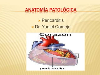 ANATOMÍA PATOLÓGICA
 Pericarditis
 Dr. Yuniel Camejo
 