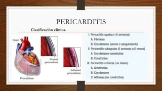 PERICARDITIS
Clasificación clínica.
 