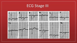 ECG Stage III
 