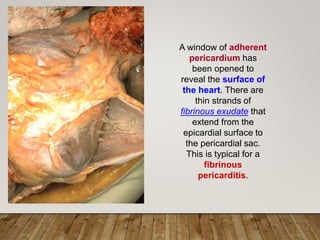 A window of adherent
pericardium has
been opened to
reveal the surface of
the heart. There are
thin strands of
fibrinous exudate that
extend from the
epicardial surface to
the pericardial sac.
This is typical for a
fibrinous
pericarditis.
 