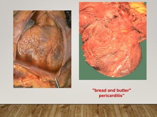"bread and butter"
pericarditis”
 