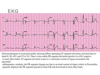 Pericarditis / nursing care | PPT