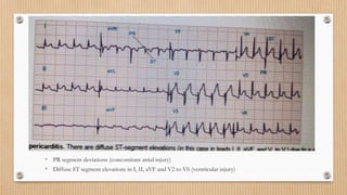 Pericarditis | PPTX