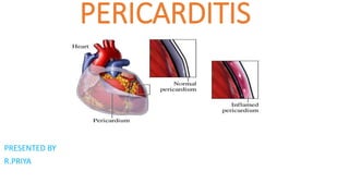 PERICARDITIS
PRESENTED BY
R.PRIYA
 