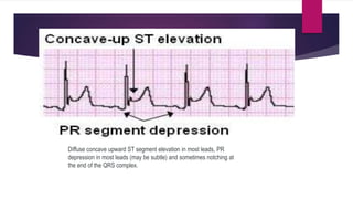 Diffuse concave upward ST segment elevation in most leads, PR
depression in most leads (may be subtle) and sometimes notching at
the end of the QRS complex.
 