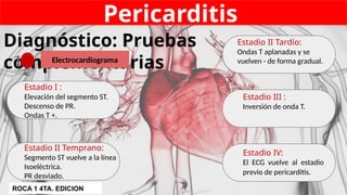 Pericarditis
Diagnóstico: Pruebas
complementarias
Electrocardiograma
1
Estadio I :
Elevación del segmento ST.
Descenso de PR.
Ondas T +.
Estadio II Temprano:
Segmento ST vuelve a la línea
Isoeléctrica.
PR desviado.
Estadio II Tardío:
Ondas T aplanadas y se
vuelven - de forma gradual.
Estadio III :
Inversión de onda T.
Estadio IV:
El ECG vuelve al estadio
previo de pericarditis.
ROCA 1 4TA. EDICION
 