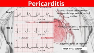 Pericarditis
Ascenso cóncavo del segmento ST,
descenso del segmento PR, onda T
positiva.
Fase 1
Normalización del ST, aplanamiento
de la onda T
Fase 2:
Negativización de la onda T.
Fase 3:
ROCA 1 4TA. EDICION
 
