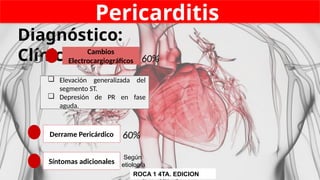 Pericarditis
Diagnóstico:
Clínico
❏ Elevación generalizada del
segmento ST.
❏ Depresión de PR en fase
aguda.
Cambios
Electrocargiográficos 60%
Derrame Pericárdico 60%
Síntomas adicionales
3
Según
etiología
ROCA 1 4TA. EDICION
 