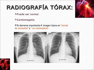 RADIOGRAFÍA TÓRAX:
  Puede ser normal.

  Cardiomegalia.

  Si derrame importante imagen típica en “tienda
  de campaña” o “ en cantimplora”.
 