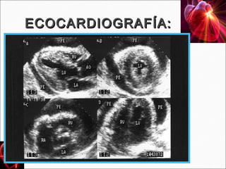 ECOCARDIOGRAFÍA:

De elección para objetivar el derrame y su cuantía: la
presencia de derrame confirma el diagnóstico de pericarditis, pero
su ausencia no lo excluye.

Urgente si sospecha de taponamiento cardíaco.

Signos de compromiso hemodinámico:
    1. Colapso AD/VD
    2. Disminución del flujo y apertura mitral con la inspiración
    3. Inmovilidad de la v. cava inferior con la inspiración
 