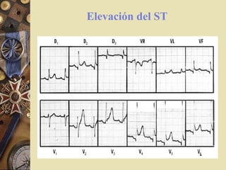 Elevación del ST
 