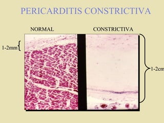 PERICARDITIS CONSTRICTIVA
NORMALNORMAL CONSTRICTIVACONSTRICTIVA
1-2mm1-2mm
1-2cm1-2cm
 