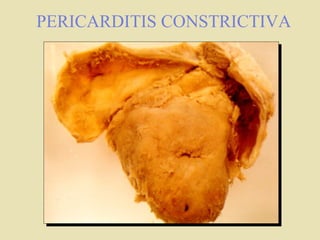PERICARDITIS CONSTRICTIVA
 