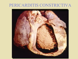 PERICARDITIS CONSTRICTIVA
 