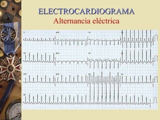 ELECTROCARDIOGRAMAELECTROCARDIOGRAMA
Alternancia eléctrica
 