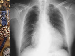  Signo de la
cantimplora
 