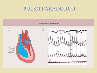 PULSO PARADÓJICO
 