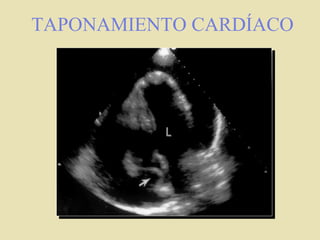TAPONAMIENTO CARDÍACO
 