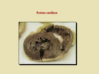 Rotura cardíacaRotura cardíaca
 