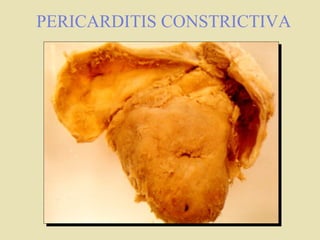 Pericarditis  Aguda 
