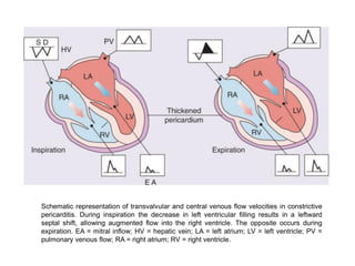 Schematic representation of transvalvular and central venous flow velocities in constrictive
pericarditis. During inspiration the decrease in left ventricular filling results in a leftward
septal shift, allowing augmented flow into the right ventricle. The opposite occurs during
expiration. EA = mitral inflow; HV = hepatic vein; LA = left atrium; LV = left ventricle; PV =
pulmonary venous flow; RA = right atrium; RV = right ventricle.
 