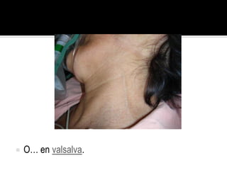   O… en valsalva.
 