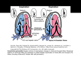 Constrictive pericarditis Doppler schema of respirophasic changes in mitral and tricuspid inflow. Reciprocal
patterns of ventricular filling are assessed on pulsed Doppler examination of mitral (MV) and tricuspid (TV)
inflow. (Courtesy of Bernard E. Bulwer, MD; with permission.)
 