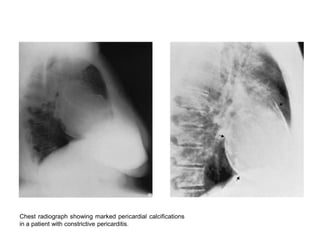 Chest radiograph showing marked pericardial calcifications
in a patient with constrictive pericarditis.
 