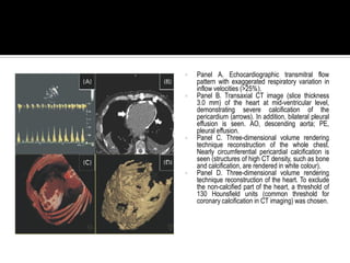    Panel A. Echocardiographic transmitral flow
    pattern with exaggerated respiratory variation in
    inflow velocities (>25%).
   Panel B. Transaxial CT image (slice thickness
    3.0 mm) of the heart at mid-ventricular level,
    demonstrating severe calcification of the
    pericardium (arrows). In addition, bilateral pleural
    effusion is seen. AO, descending aorta; PE,
    pleural effusion.
   Panel C. Three-dimensional volume rendering
    technique reconstruction of the whole chest.
    Nearly circumferential pericardial calcification is
    seen (structures of high CT density, such as bone
    and calcification, are rendered in white colour).
   Panel D. Three-dimensional volume rendering
    technique reconstruction of the heart. To exclude
    the non-calcified part of the heart, a threshold of
    130 Hounsfield units (common threshold for
    coronary calcification in CT imaging) was chosen.
 