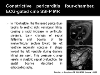    In mid-diastole, the thickened pericardium
    begins to restrict right ventricular filling,
    causing a rapid increase in ventricular
    pressure. Early changes of septal
    flattening     and     bowing     of      the
    interventricular septum toward the left
    ventricle (normally concave in shape
    toward the left ventricle during diastolic
    filling) are seen. This pressure change
    results in diastolic septal dysfunction, the
    septal       bounce       described         in
    echocardiography.
                                          Frontiers in Bioscience 14, 2688-2703, January 1, 2009
 