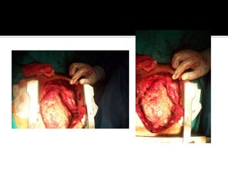 Pericarditis constrictiva