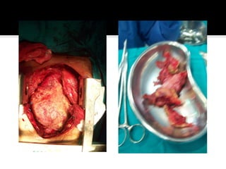 Pericarditis constrictiva