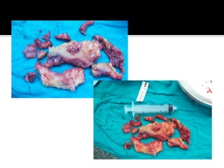 Pericarditis constrictiva