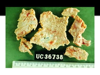 Pericarditis constrictiva