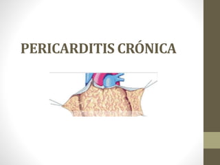 PERICARDITIS CRÓNICA 
 