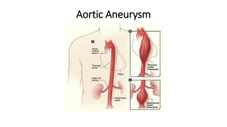 Aortic Aneurysm
 